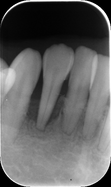 右下側切歯